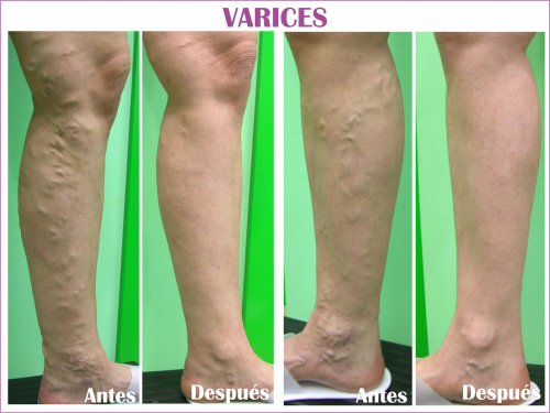 Eliminaci�n varices